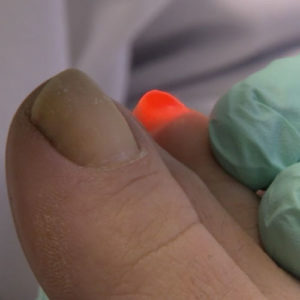 toe nail fungus laser removal